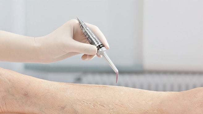 Askina Calgitrol Paste kleine 15-g-Tube in einer Hand mit Untersuchungshandschuhen, die auf ein menschliches Bein aufgetragen wird