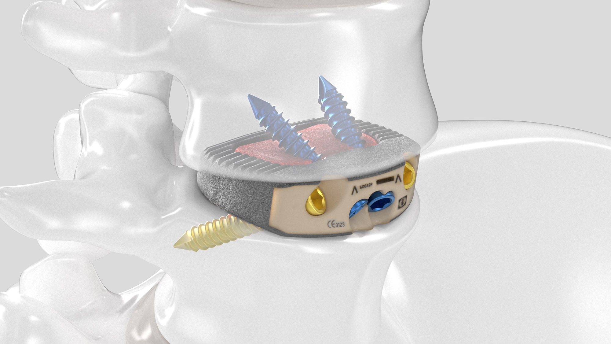 Leichte Draufsicht des eingesetzten Aesculap Arcadius XP L Implantats in einem Wirbelsäulenmodell