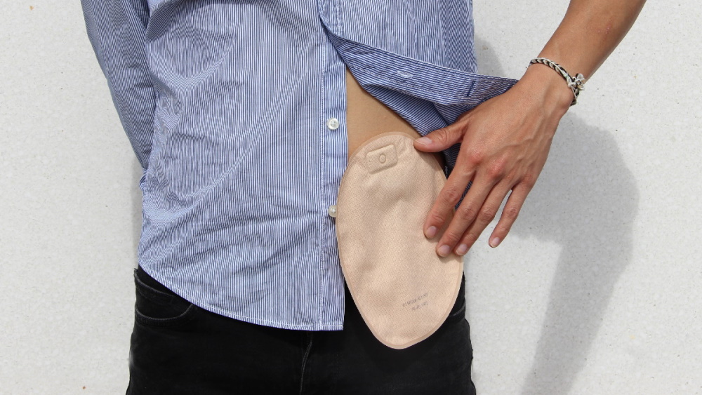 Was ist ein Stoma? Erläuterung der Stomafunktionen und typen