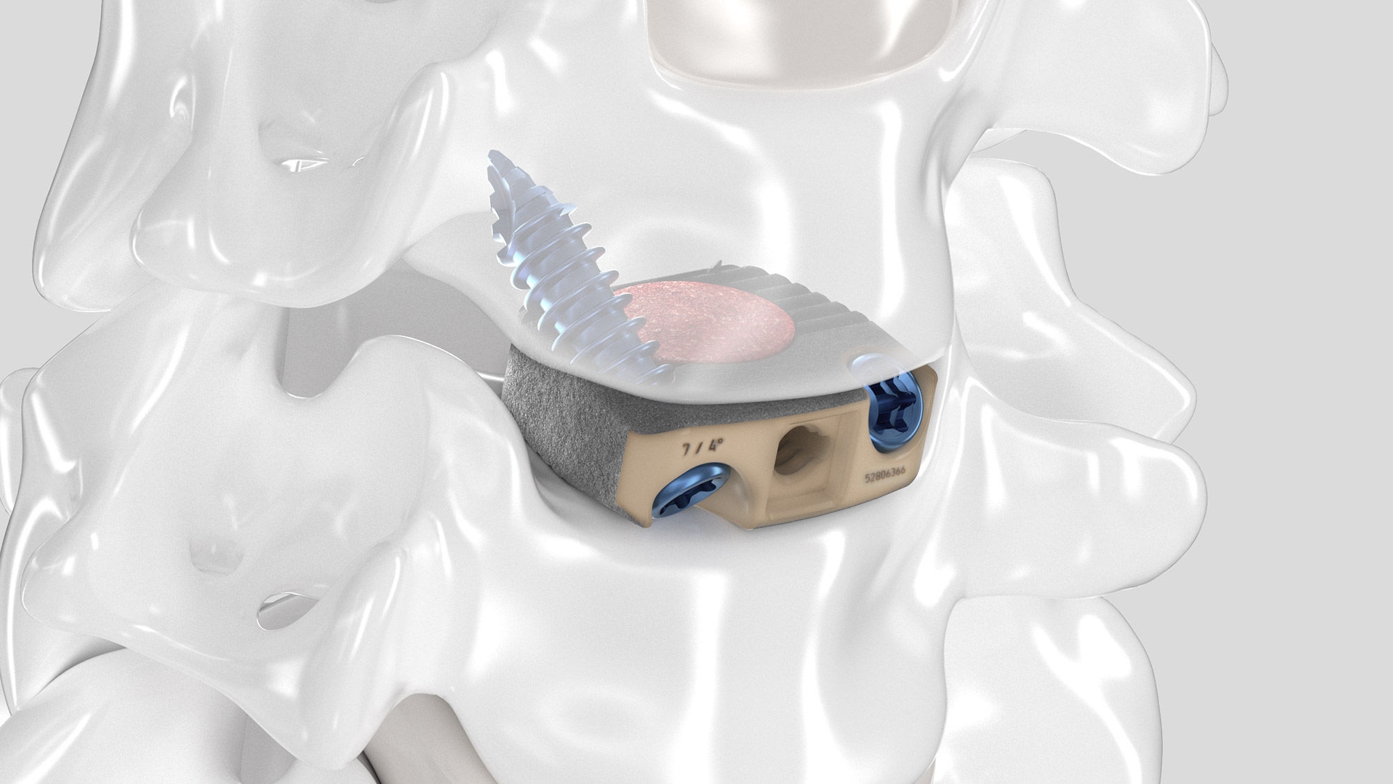 Leichte Draufsicht des eingesetzten Aesculap Arcadius XP C Implantats in einem Wirbelsäulenmodell