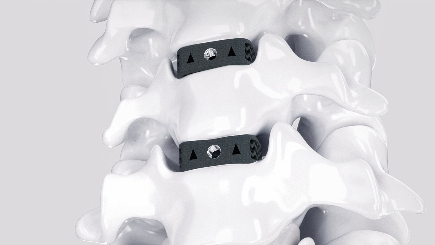 Wirbelsäulenmodell mit Ennovate® und 3D-Cages