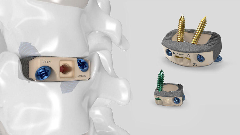 aesculap plasmapore xp anterior Stand-alone-Wirbelkörpergeräte